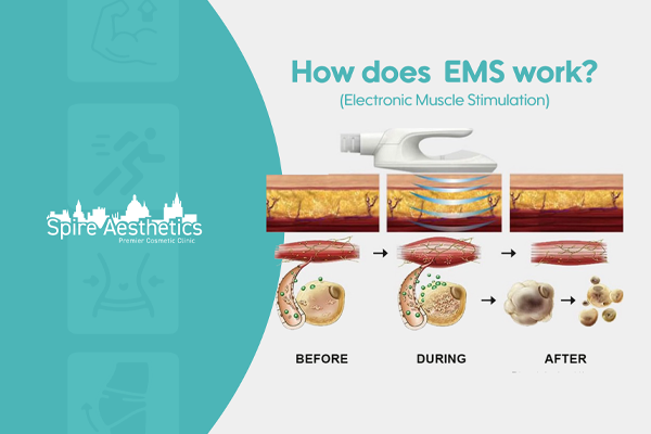EMS treatment for post pregnancy weight loss treatment Stirling