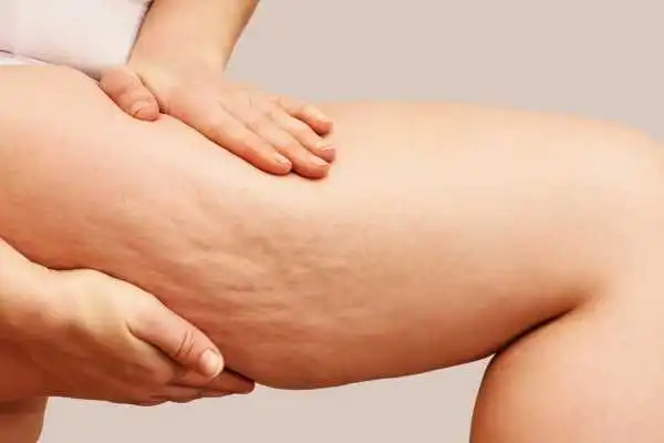 Image of woman showing leg with cellulite Stirling