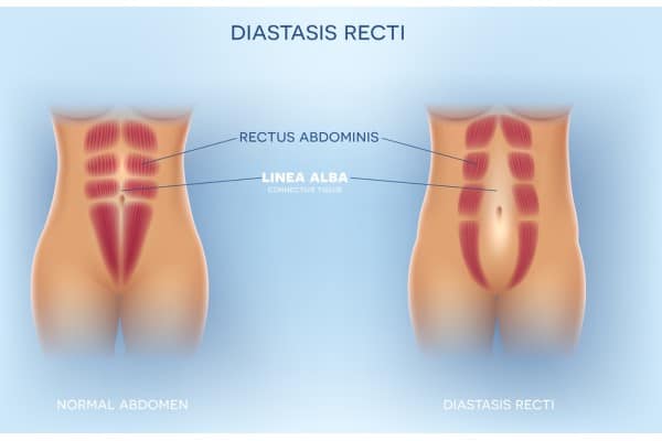 What Non-Surgical Options Are Available for Diastasis Recti Stirling?