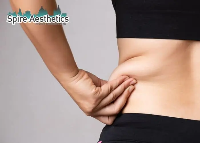 Image of woman pinching fat on their hips Stirling. Fat Freezing treatment