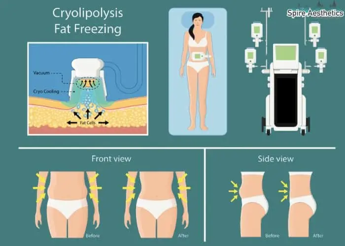 Fat freezing treatment Stirling benefits for competitions to remove stubborn fat deposits.