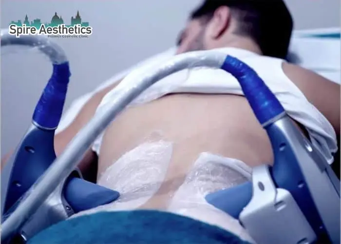 Man having fat freezing treatment done on love handles before a competitions Stirling to create a sculpted look.
