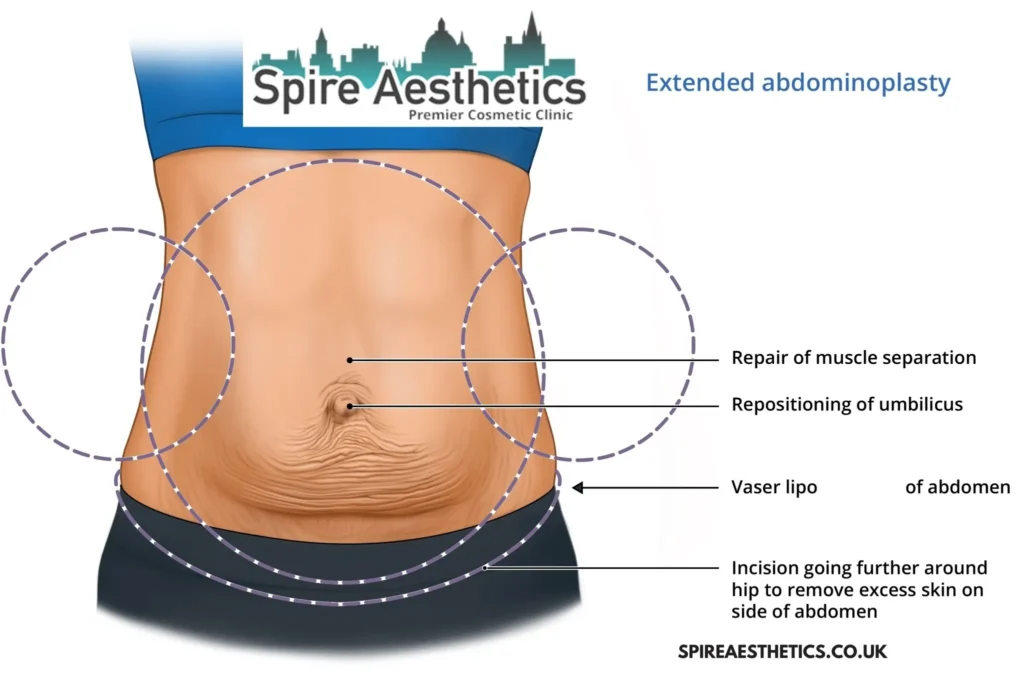 Understanding Loose Skin After Gastric Band Stirling Surgery and HIFU Treatment