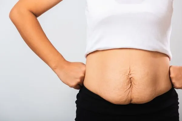 Image of a woman's stomach after weight loss with sagging skin following a gastric band Stirling