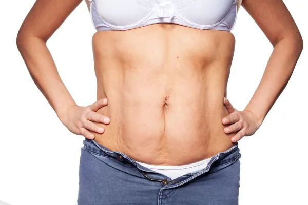 sagging skin on woman's stomach after weight loss injections Stirling
