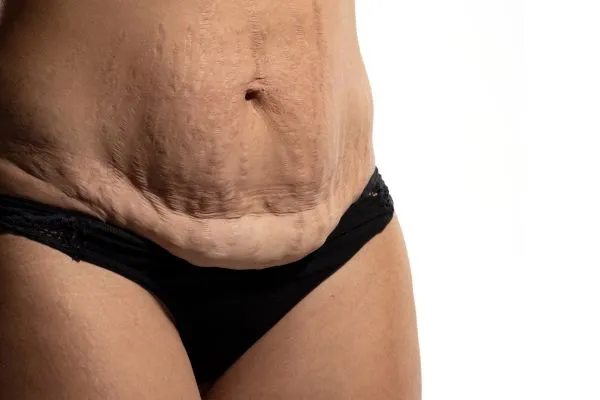 Image of womans stomach after weight loss injections Stirling showing saggy skin