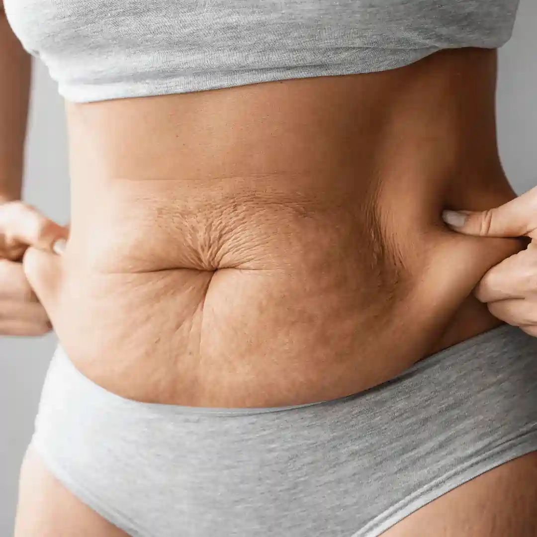 Is It Normal to Have Loose Skin After Pregnancy Stirling?